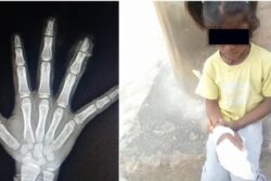 Karnataka Girl's Fingers Severed In School, Parents Say Staff Discarded Them